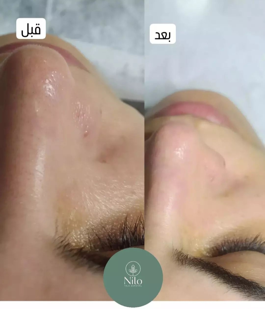 پاکسازی پوست