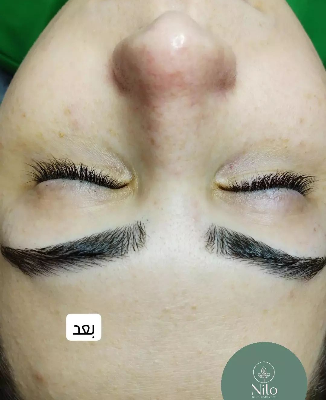 قبل و بعد پاکسازی پوست